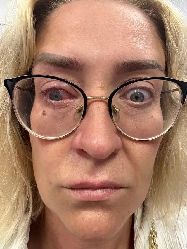 Katie lost the vision in her right eye.