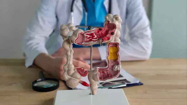 Colon Cancer Deaths Rising in People Under 50